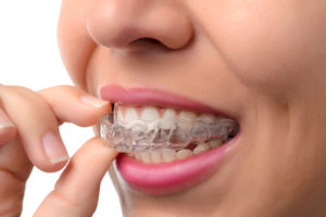 clear braces - invisalign 